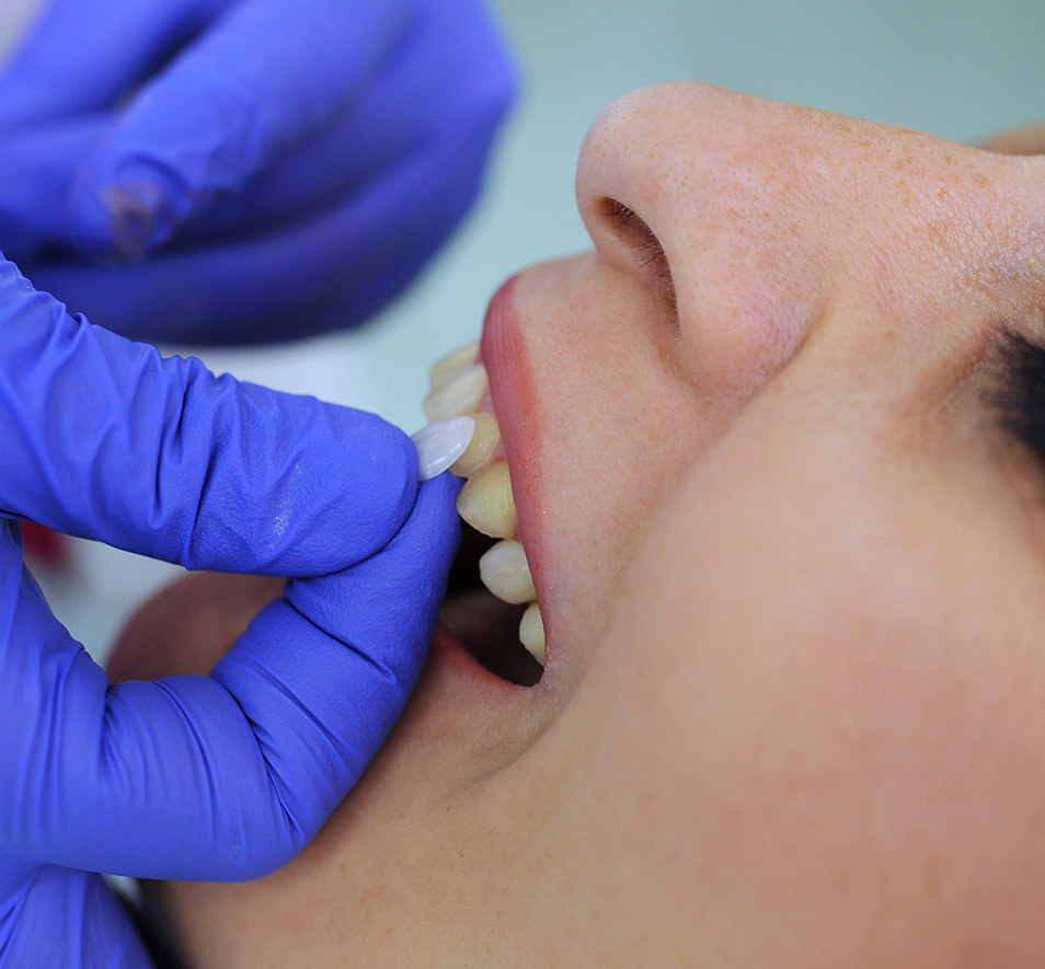 Veneers Mesa View Dental Veneers mesa view dental